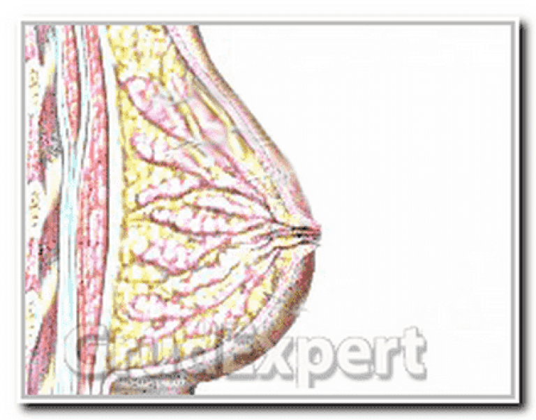 Дуктэктазия молочной железы что это. Эктазия млечных протоков. Эктазия протоков молочных желез. Дуктэктазия протоков молочной железы. Экиащия протоклв молочноц железы.