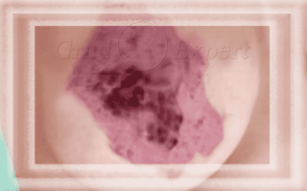 рожистый рак молочной железы фото